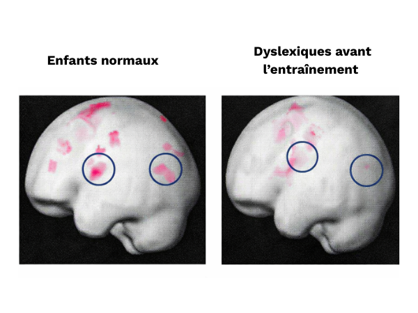 Imagerie du cerveau comparant enfants normaux et enfants avec dyslexie avant entrainement